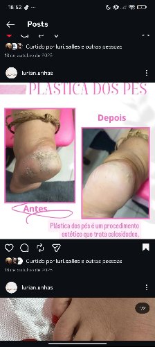 plástica dos pés 