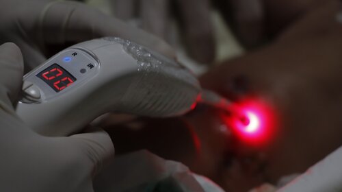 Laserterapia 